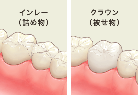 ジルコニア(インレー/クラウン)