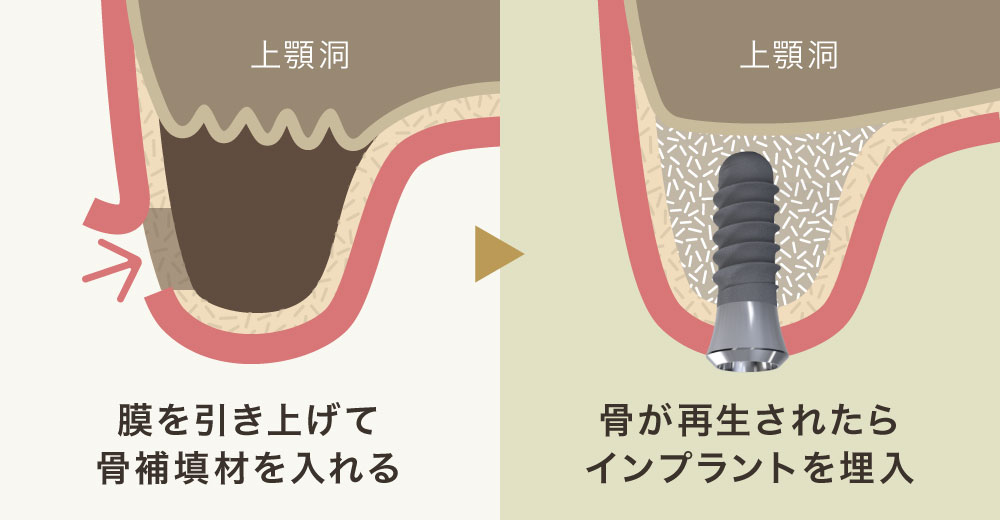 サイナスリフト