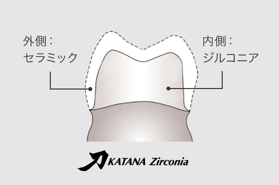 カタナジルコニアクラウンレイヤリング