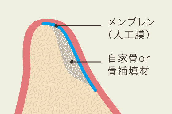 GBR(骨造成)
