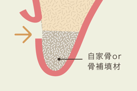 サイナスリフト