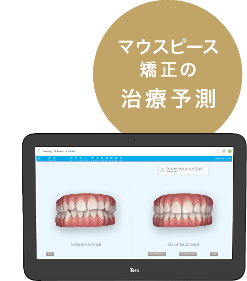 マウスピース矯正の治療予測