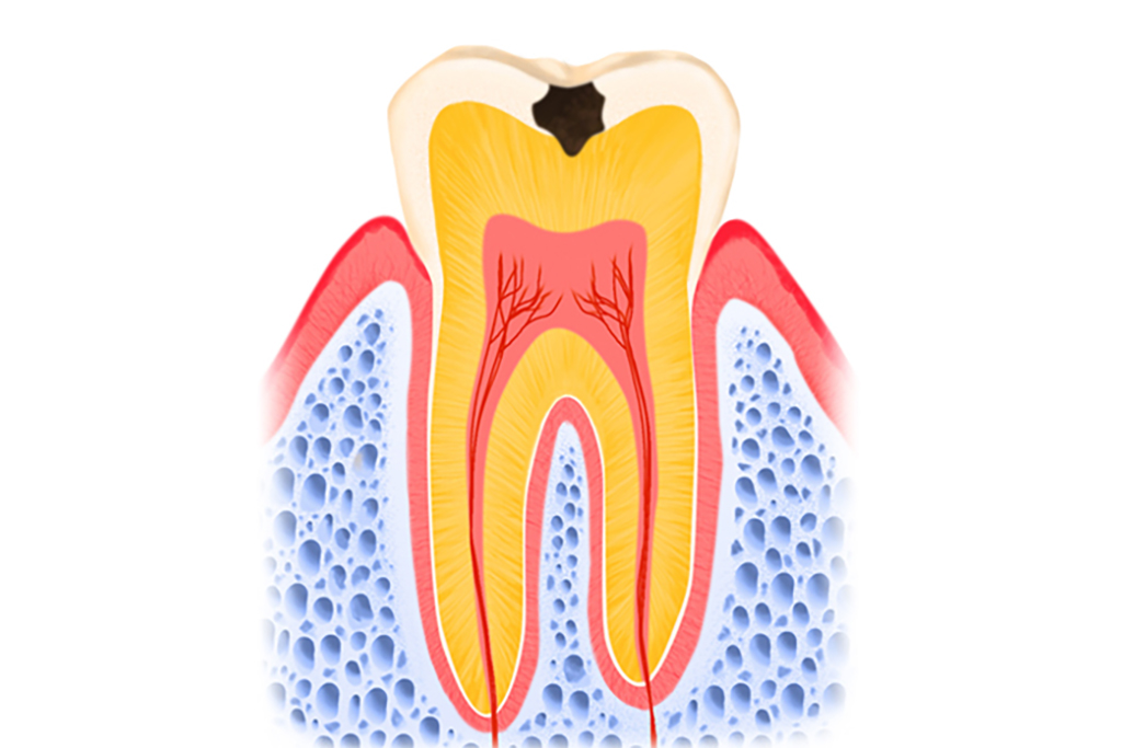エナメル質にできたむし歯（C1）