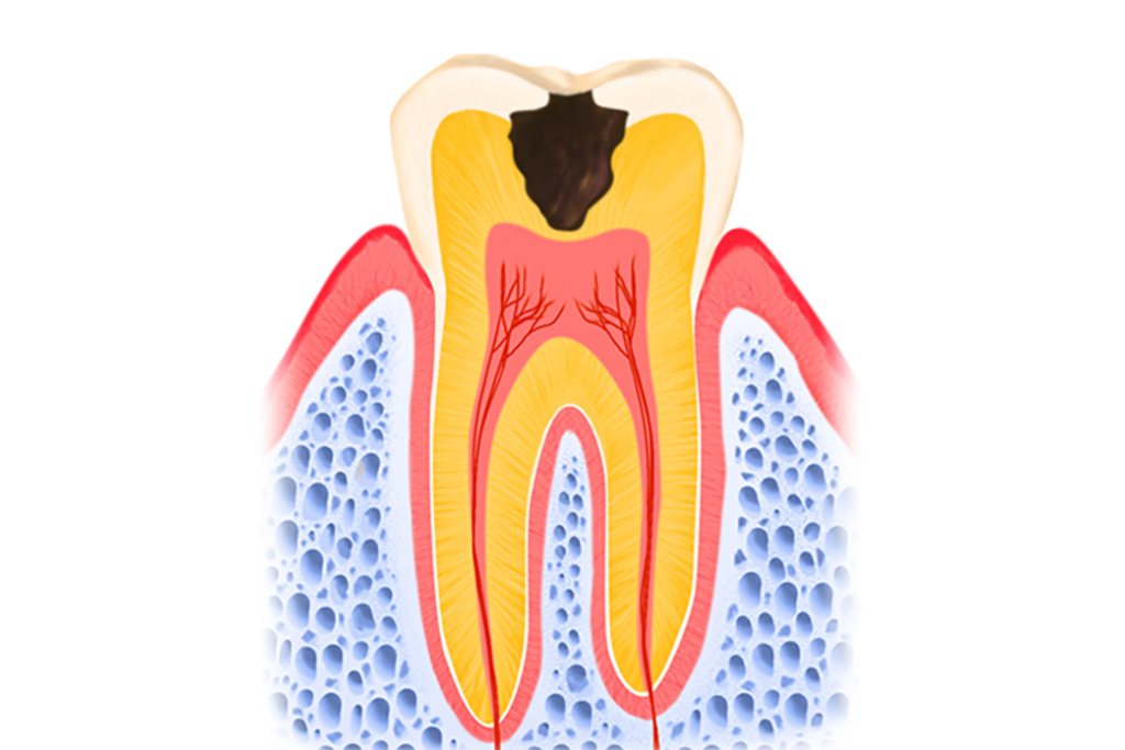 象牙質まで進行したむし歯（C2）