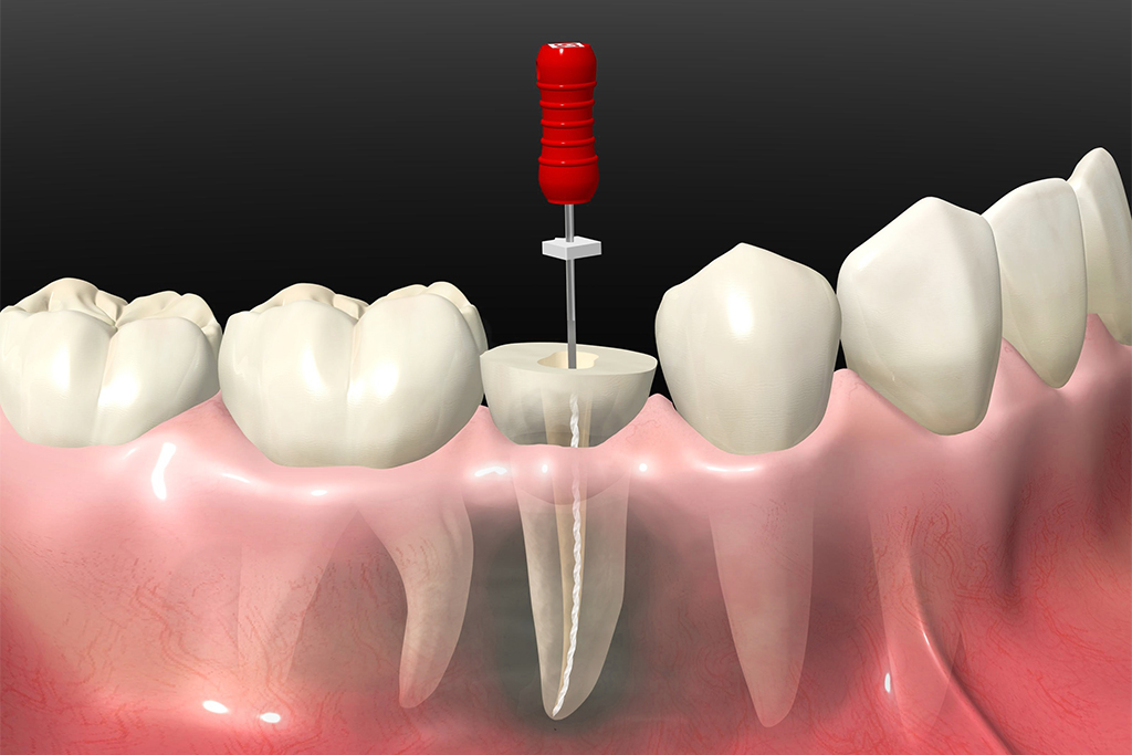 歯の根のむし歯の再発を防ぐ治療