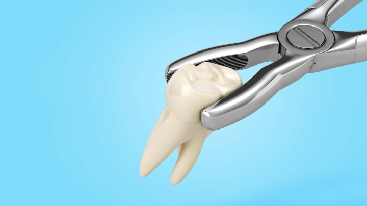 抜歯のイメージ