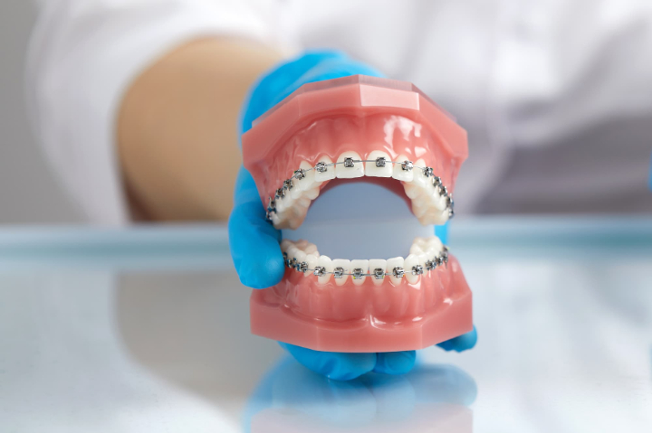 ワイヤー矯正の模型