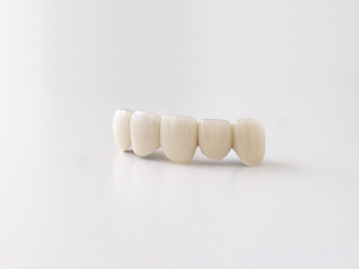 セラミックでできた前歯のブリッジ