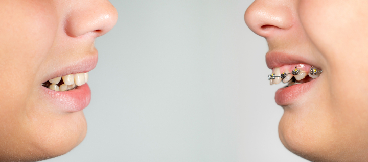 矯正治療中の歯並びの悪い子ども