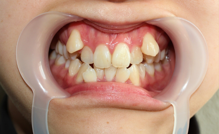 矯正を検討したほうがよい子どもの歯並びの症例