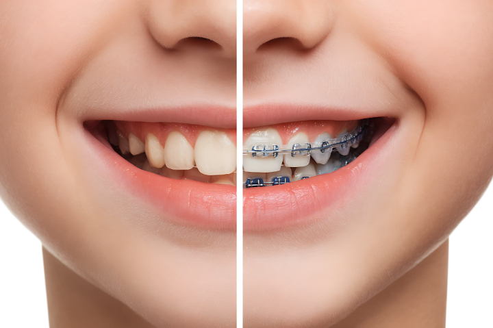 審美歯科治療を受けた前後のイメージ