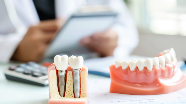 インプラント治療にかかる費用を説明するイメージ
