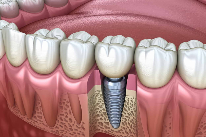 インプラント治療の断面図